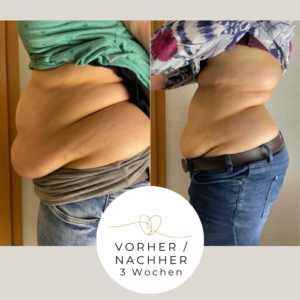 Vergleich Bauch vor und nach Tupler Technik Training zur Schließung der Rektusdiastase