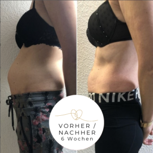 Ergebnis einer Rektusdiastase-Behandlung mit der Tupler Technik bei bellycare